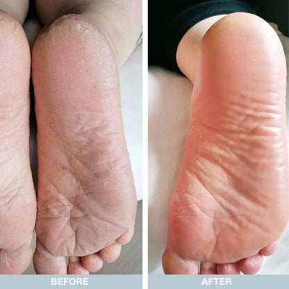 Cracked Heels Removal