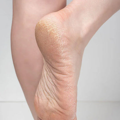 Cracked Heels Removal